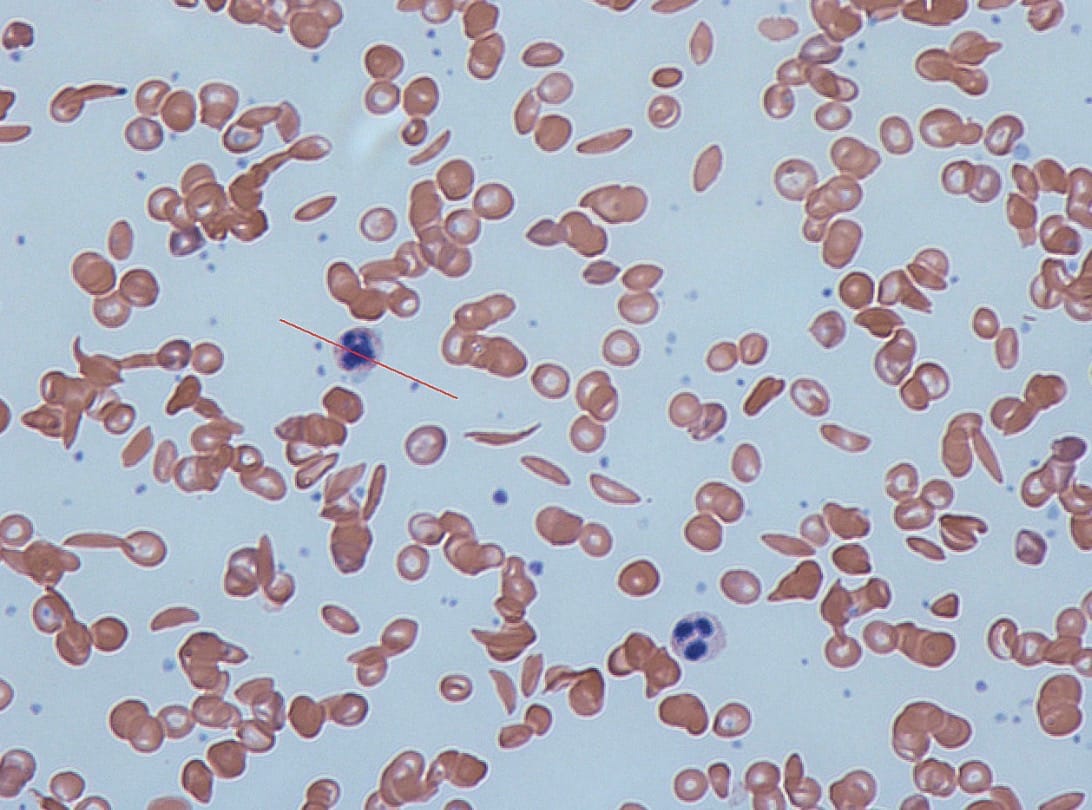 Can We Rewrite Blood? How Gene-edited Stem Cells Can Treat Sickle Cell disease