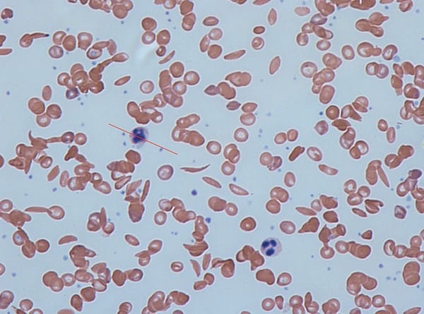 Can We Rewrite Blood? How Gene-edited Stem Cells Can Treat Sickle Cell disease